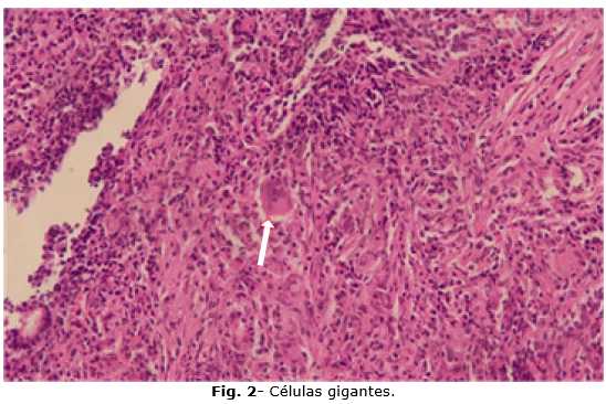 prostatitis crónica histologia