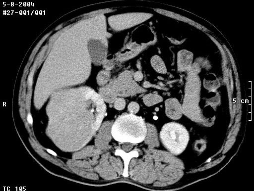 tac tumor