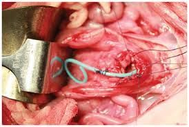 cir fistula