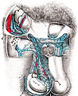 varicocele