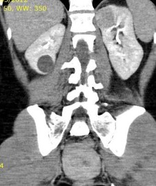 tumor