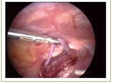 varicocele laparoscopico