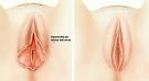 Hipertrofia de labios menores