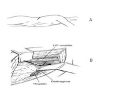 nefrostomia combinada